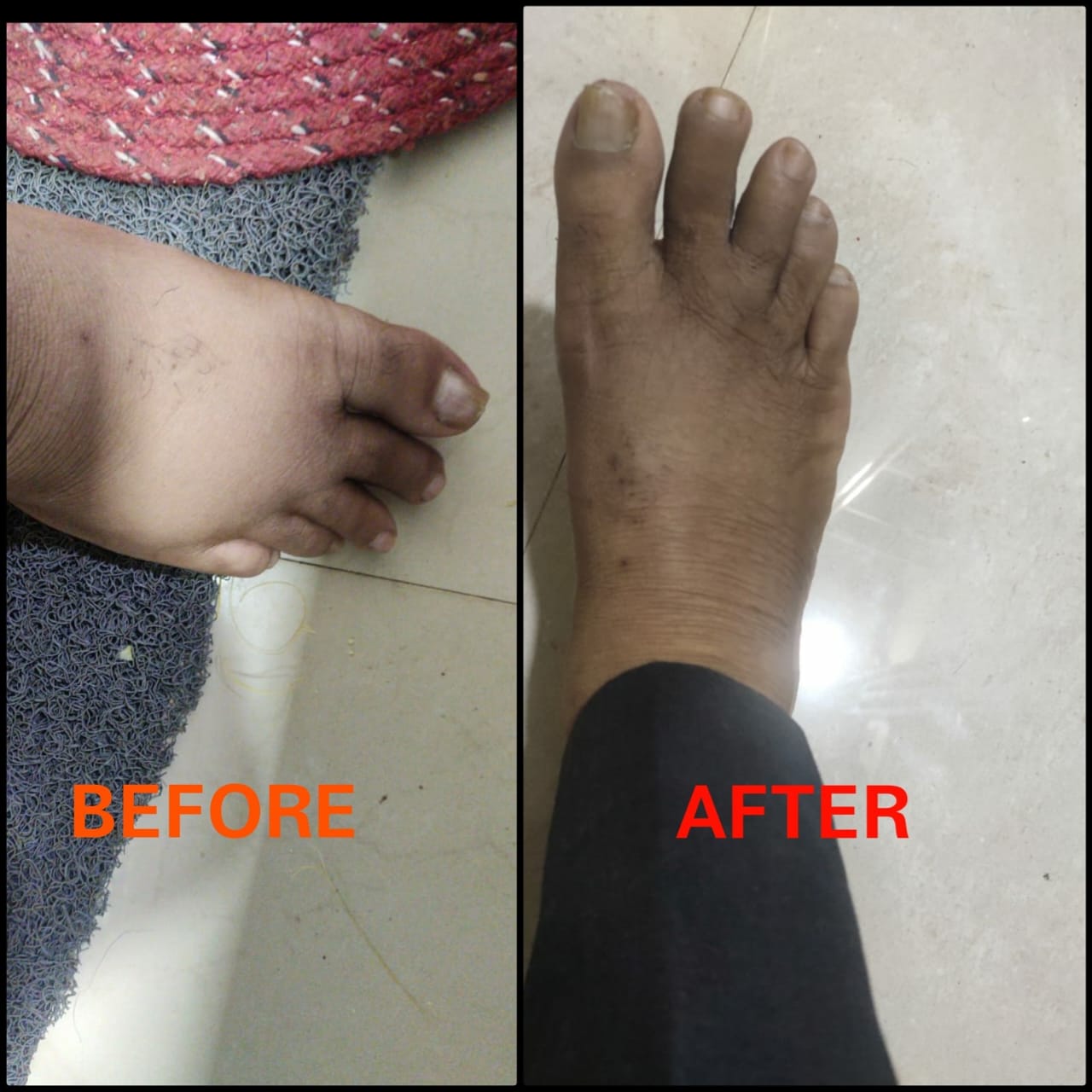 leg injure